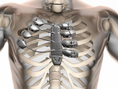 Titanium Bone Implant