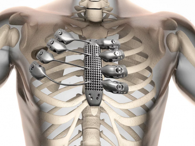 titanium bone implant