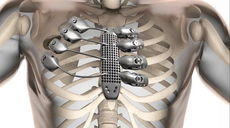 Titanium Bone Implant