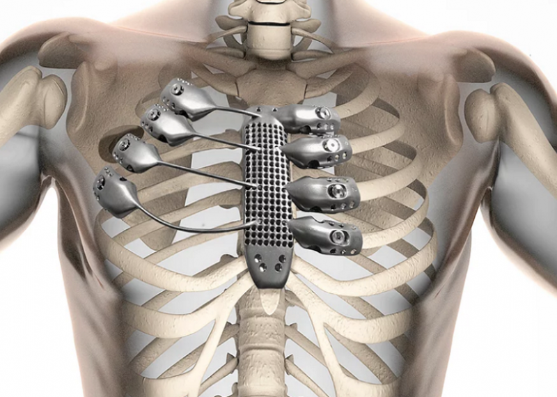titanium bone implant