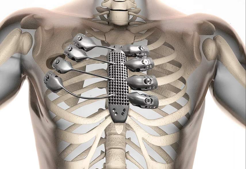Titanium Bone Implant titanium bone implant