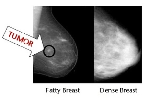 Tumor is not clear in a dense breast x-ray film