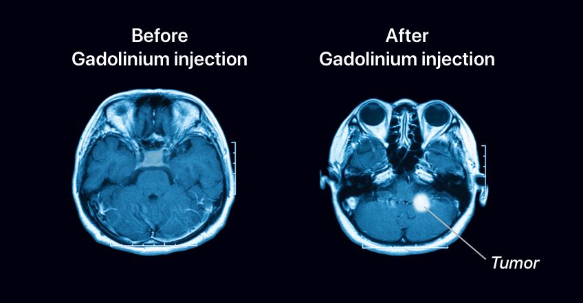 Gadolinium is used in contrast solutions for magnetic resonance imaging (MRI) scans.